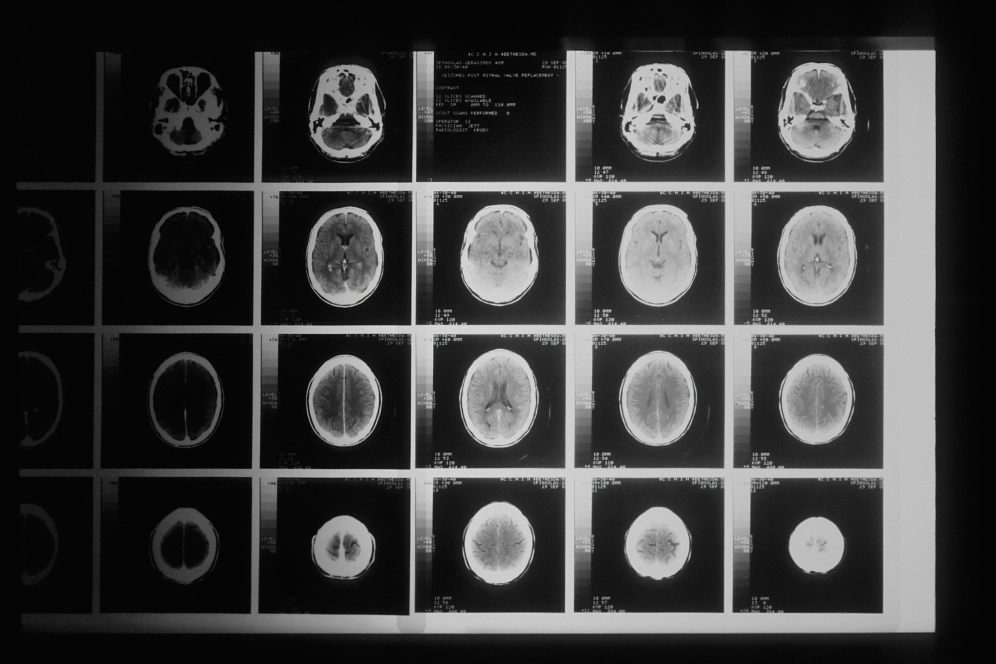 Black-and-white sheet of axial brain CT slices on a light box, with patient name, date and scanner details printed in the margins.